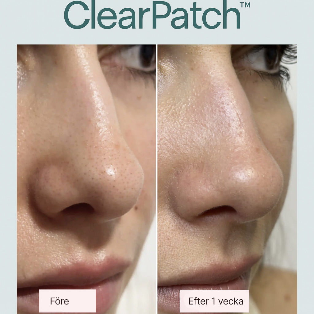 ClearPatch™ – För rena, fria porer