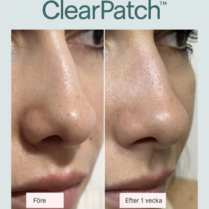 ClearPatch™ – För rena, fria porer